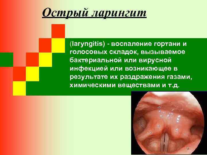 Острый ларингит (laryngitis) - воспаление гортани и голосовых складок, вызываемое бактериальной или вирусной инфекцией