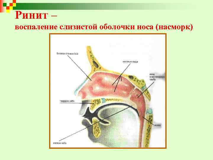 Ринит – воспаление слизистой оболочки носа (насморк) 