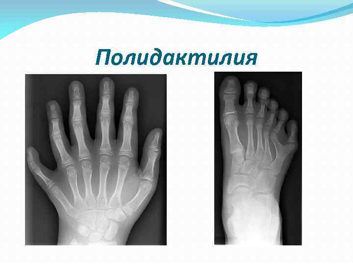 Полидактилия 
