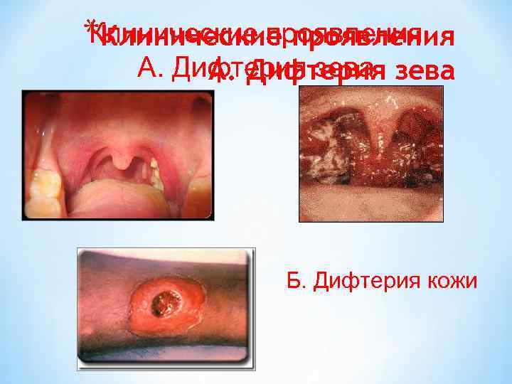 Клинические проявления *Клинические проявления А. Дифтерия зева А. Дифтерия Б. Дифтерия кожи 