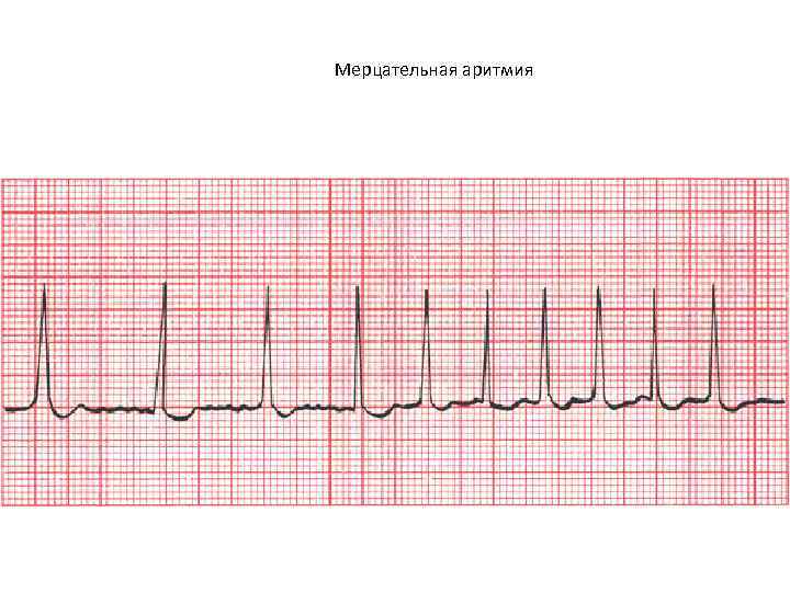 Мерцательная аритмия 