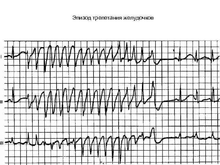 Эпизод трепетания желудочков 