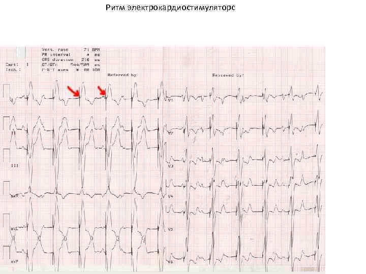 Ритм электрокардиостимуляторс 