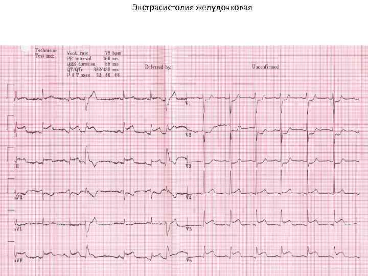 Экстрасистолия желудочковая 