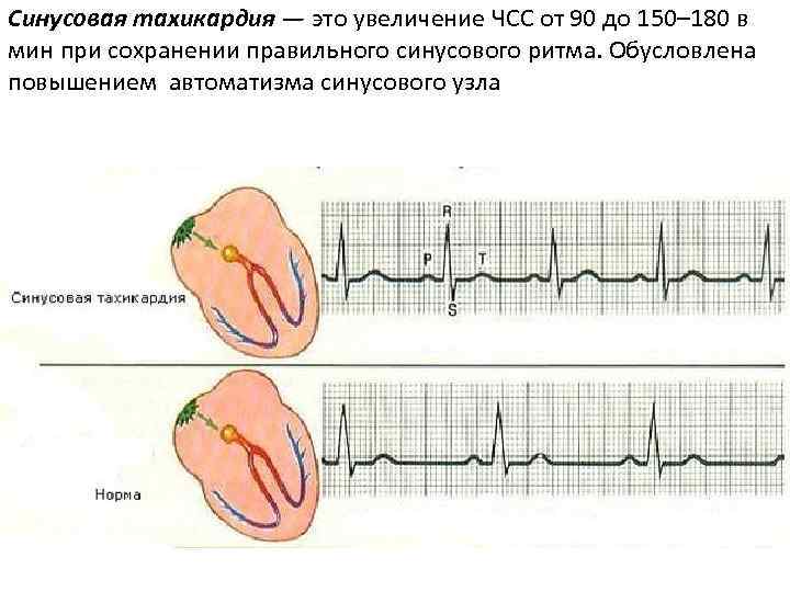 Синусовая тахикардия — это увеличение ЧСС от 90 до 150– 180 в мин при