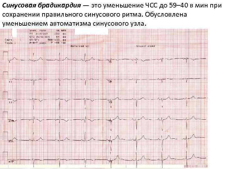 Синусовая брадикардия что это. ЧСС при синусовой брадикардии. Брадикардия это снижение ЧСС. ДСУ синусовая брадикардия. При синусовой брадикардии число сердечных сокращений уменьшается до.