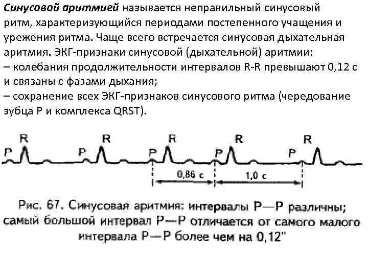 Синусовой аритмией называется неправильный синусовый ритм, характеризующийся периодами постепенного учащения и урежения ритма. Чаще