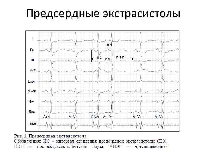 Предсердные экстрасистолы 