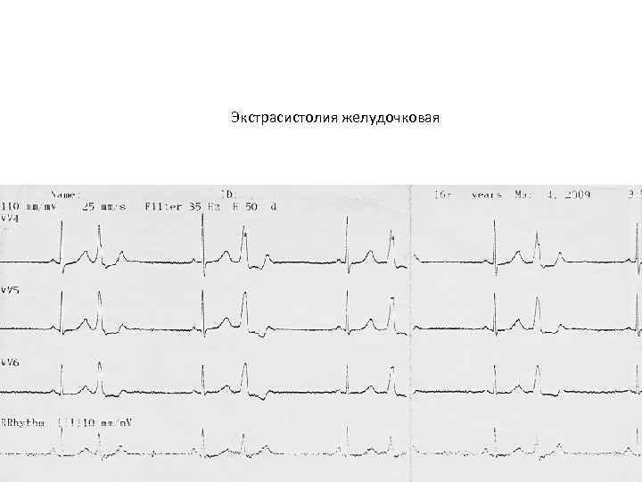 Экстрасистолия желудочковая 