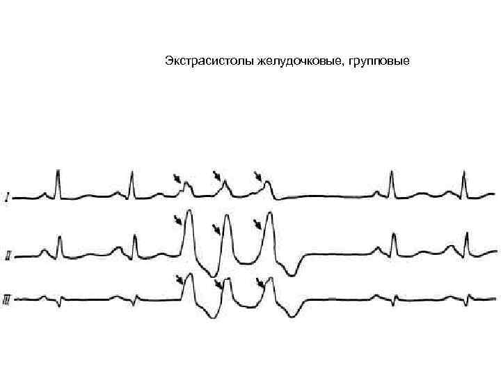 Экстрасистолы желудочковые, групповые 