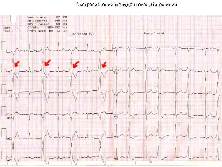 Экстрасистолия желудочковая, бигеминия 