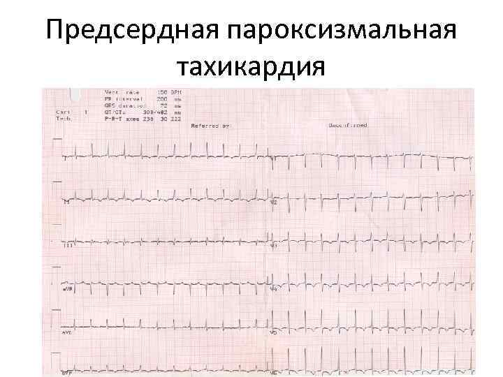 Предсердная пароксизмальная тахикардия 
