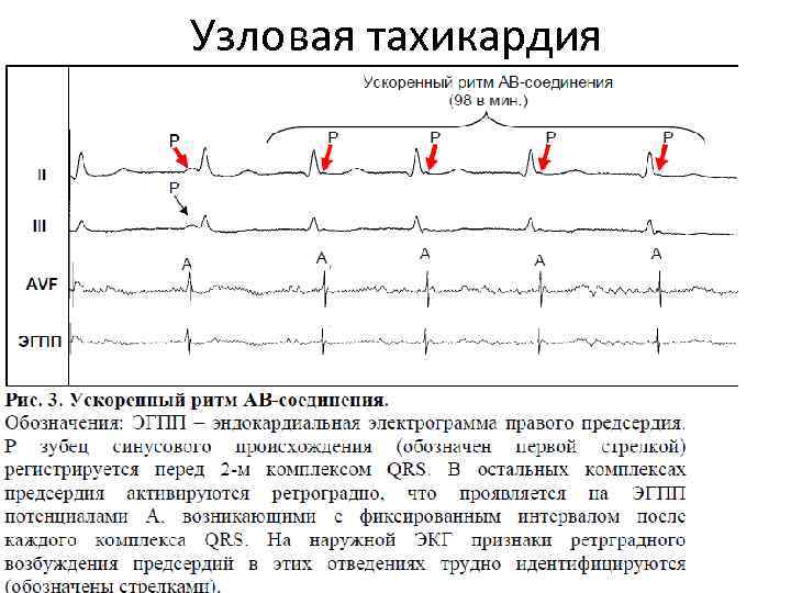 Узловая тахикардия 