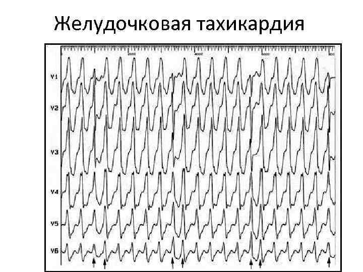 Желудочковая тахикардия 
