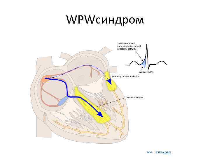 WPWсиндром 