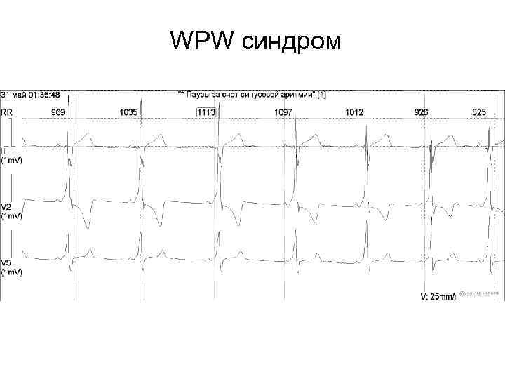 WPW синдром 