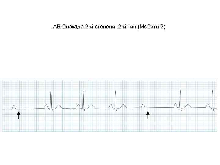 Ав блокада 2. ЭКГ атриовентрикулярная блокада Мобитц 2. Av блокада Мобитц 2 ЭКГ. АВ блокада 2 Мобитц 2 на ЭКГ. АВ блокада 2 степени Мобитц 3.