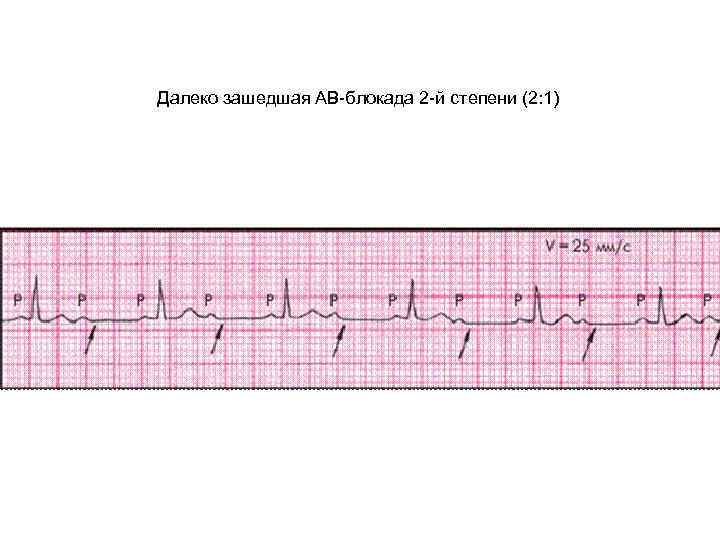 Далеко зашедшая АВ-блокада 2 -й степени (2: 1) 