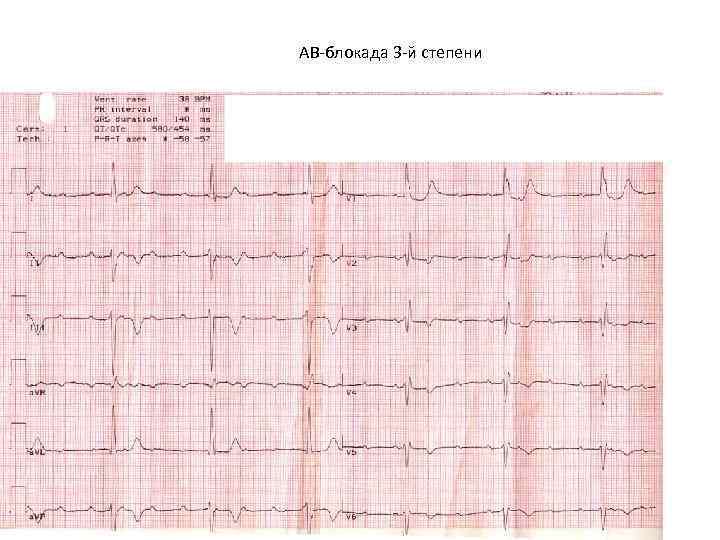 Ав блокада 3 степени на экг картинки