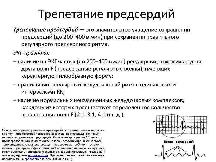 Трепетание предсердий — это значительное учащение сокращений предсердий (до 200– 400 в мин) при