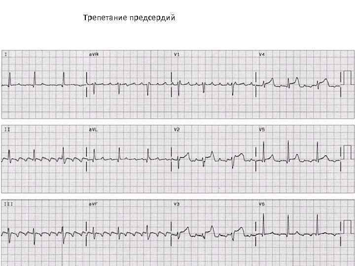 Трепетание предсердий 
