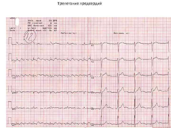 Трепетание предсердий 