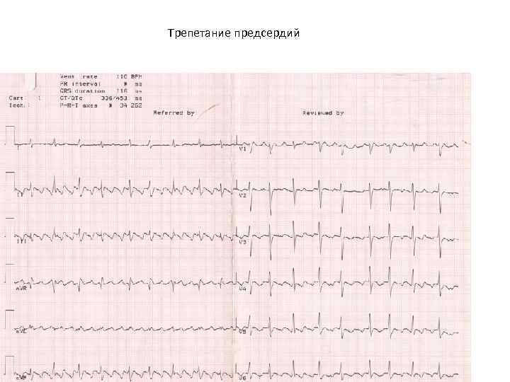 Трепетание предсердий 