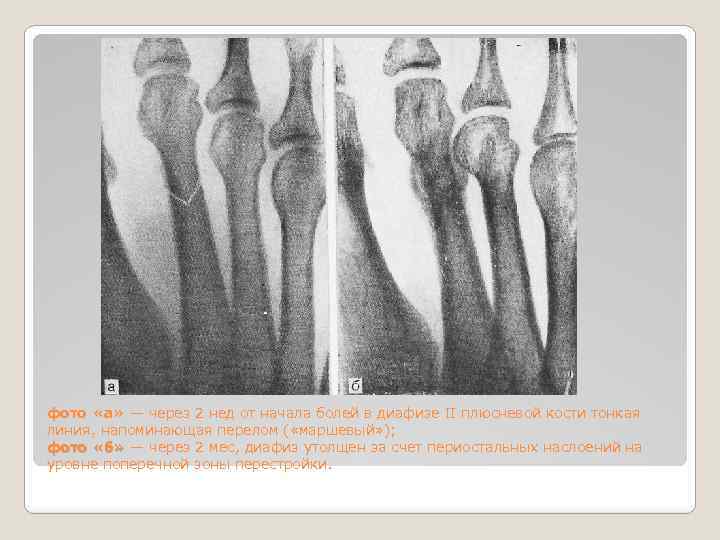 фото «а» — через 2 нед от начала болей в диафизе II плюсневой кости