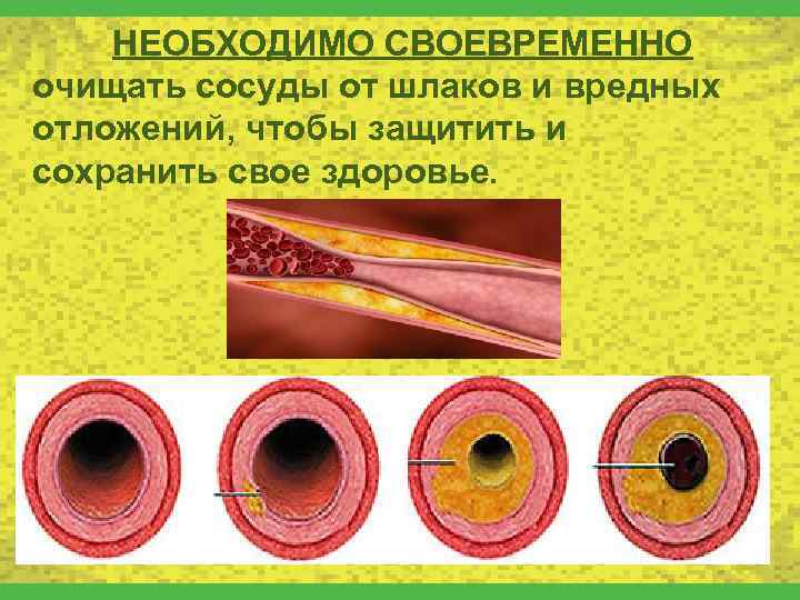 НЕОБХОДИМО СВОЕВРЕМЕННО очищать сосуды от шлаков и вредных отложений, чтобы защитить и сохранить свое