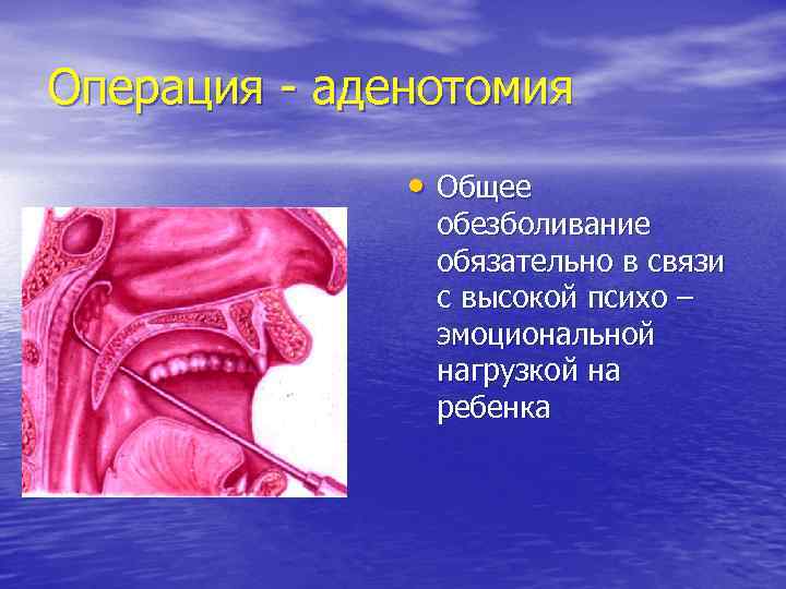 Операция - аденотомия • Общее обезболивание обязательно в связи с высокой психо – эмоциональной
