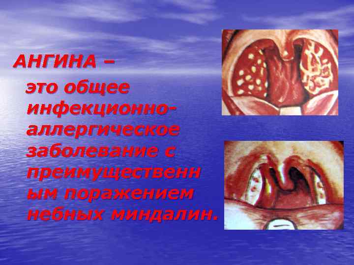 АНГИНА – это общее инфекционноаллергическое заболевание с преимущественн ым поражением небных миндалин. 