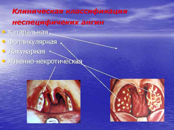 Клиническая классификация • • неспецифичеких ангин Катаральная Фолликулярная Лакунарная Язвенно-некротическая 