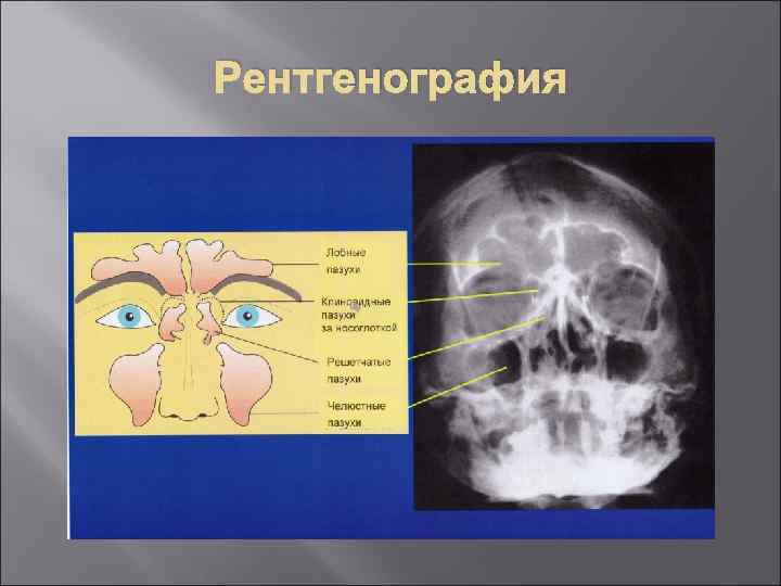 Рентгенография 