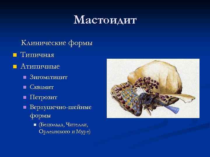 Мастоидит n n Клинические формы Типичная Атипичные n n Зигоматицит Сквамит Петрозит Верхушечно-шейные формы