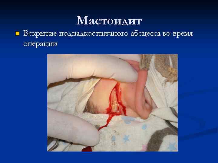 Мастоидит n Вскрытие поднадкостничного абсцесса во время операции 