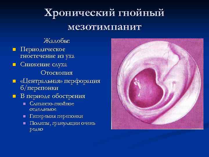 Хронический гнойный мезотимпанит n n Жалобы: Периодическое гноетечение из уха Снижение слуха Отоскопия «Центральная»