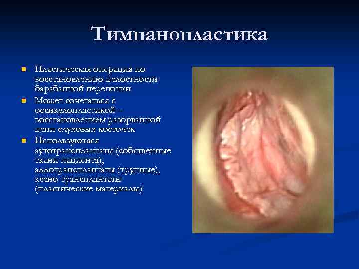 Тимпанопластика n n n Пластическая операция по восстановлению целостности барабанной перепонки Может сочетаться с