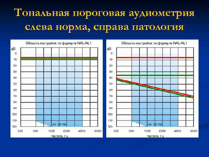 Тональная пороговая аудиометрия слева норма, справа патология 