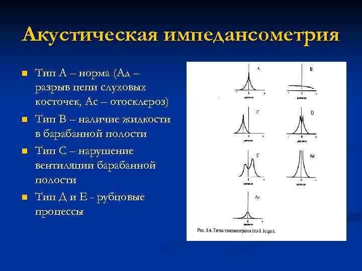 Акустическая импедансометрия n n Тип А – норма (Ад – разрыв цепи слуховых косточек,