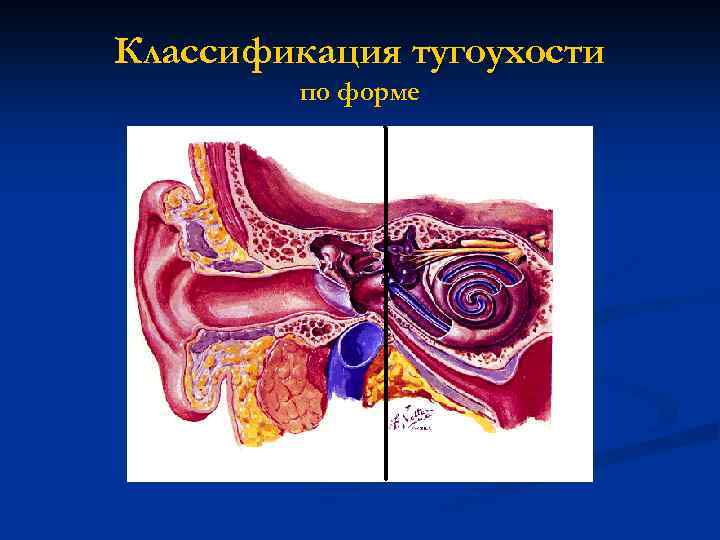 Классификация тугоухости по форме 