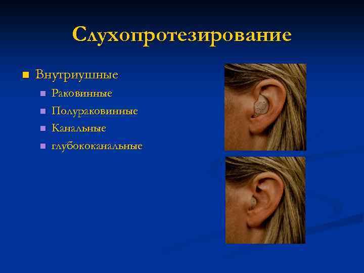 Слухопротезирование n Внутриушные n n Раковинные Полураковинные Канальные глубококанальные 