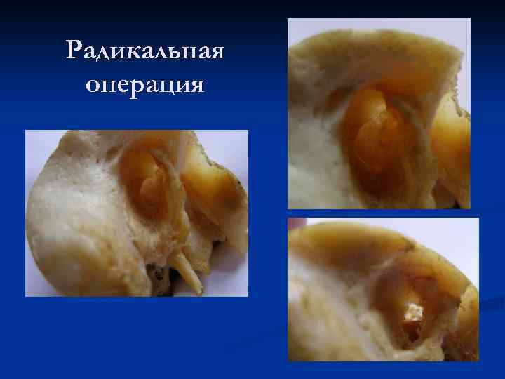 Радикальная операция 