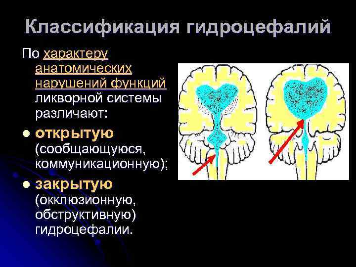 Классификация гидроцефалий По характеру анатомических нарушений функций ликворной системы различают: l открытую l закрытую