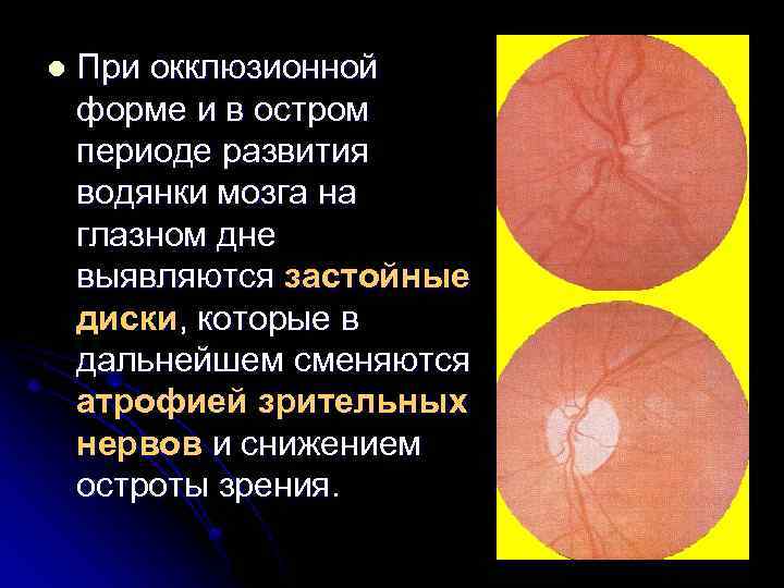 l При окклюзионной форме и в остром периоде развития водянки мозга на глазном дне