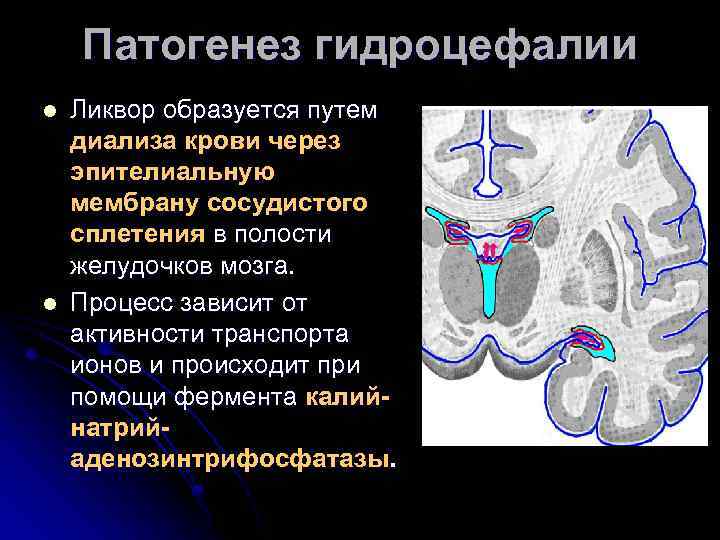 Патогенез гидроцефалии l l Ликвор образуется путем диализа крови через эпителиальную мембрану сосудистого сплетения