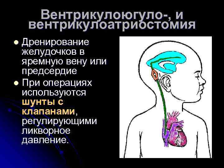 Вентрикулоюгуло-, и вентрикулоатриостомия Дренирование желудочков в яремную вену или предсердие l При операциях используются