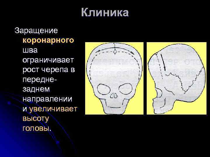 Клиника Заращение коронарного шва ограничивает рост черепа в переднезаднем направлении и увеличивает высоту головы.