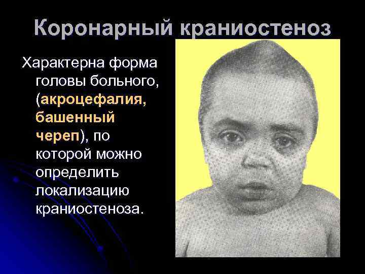 Коронарный краниостеноз Характерна форма головы больного, (акроцефалия, башенный череп), по которой можно определить локализацию