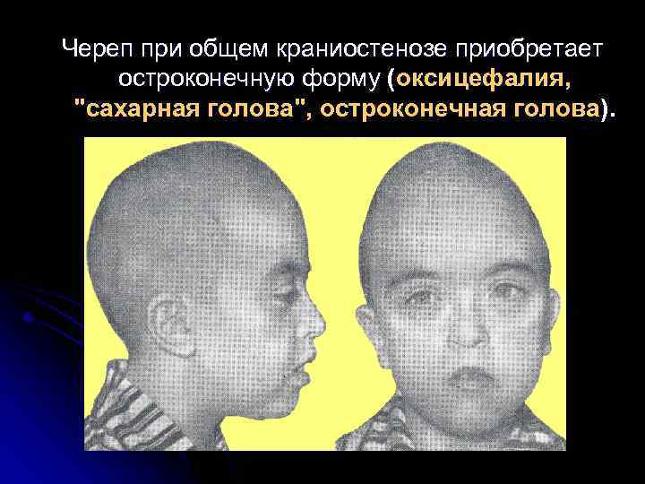 Череп при общем краниостенозе приобретает остроконечную форму (оксицефалия, 