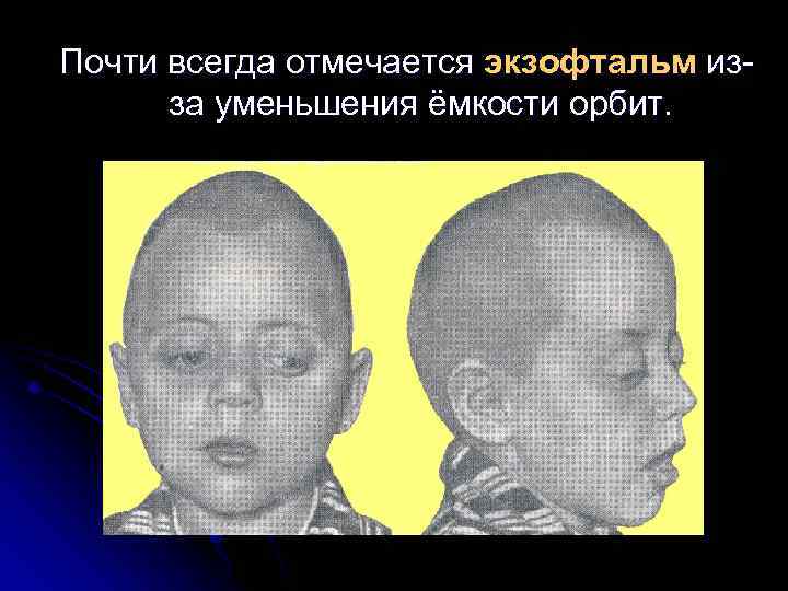 Почти всегда отмечается экзофтальм изза уменьшения ёмкости орбит. 